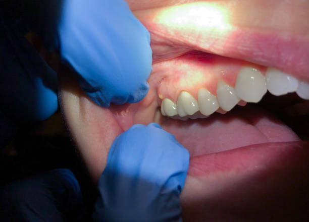 Best Emergency Treatment for Dental Infections or Abscesses in Oakland, PA